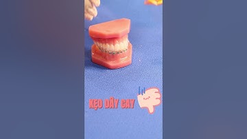 ĐỒ ĂN NÀO AN TOÀN CHO RĂNG NIỀNG: Kẹo dây cay #drcuong #nhakhoa #niengrang