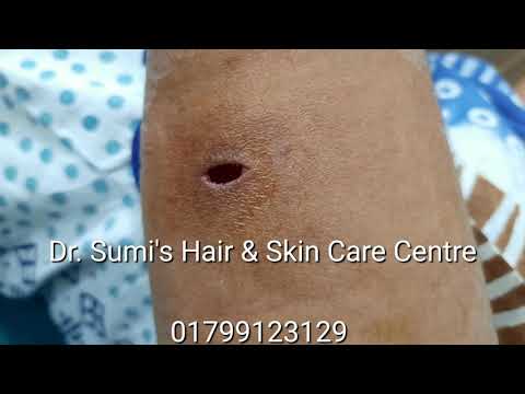 Skin Cyst || Rare Skin Tumor || Pilomatricoma || Hair Roots Tumor || 01799123129