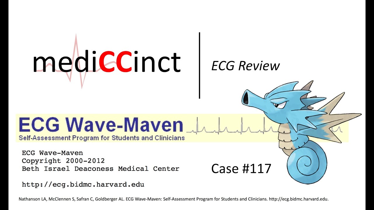 Accelerated Idioventricular Rhythm (AIVR) (ECG Wave-Maven) Case 