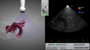HeartWorks Aortic Dissection