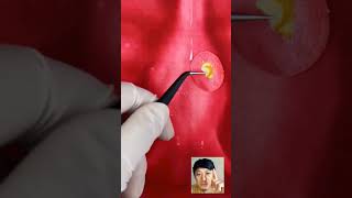 ASMR Canker Mouth Ulcer Treatment Tonsil Stone Removal Animation asmr shorts