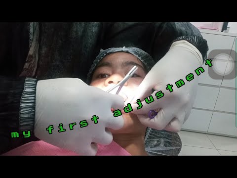 MY FIRST BRACES ADJUSTMENT 🥴