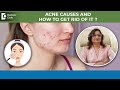 ACNE Treatment &amp; Causes | Acne diet Do&#39;s &amp; Don&#39;ts | Types of Acne - Dr.Minu Jain | Doctors&#39; Circle