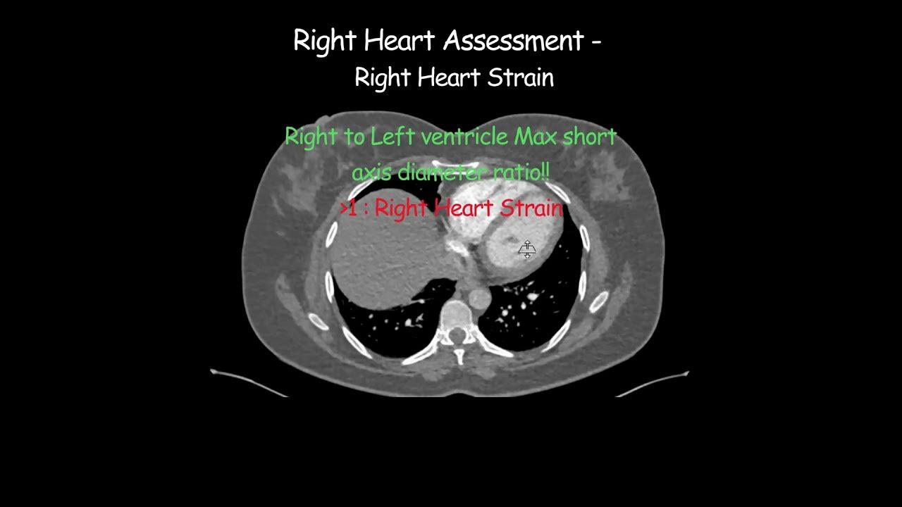 Ct pulmonary angiogram right heart assessment right heart strain 