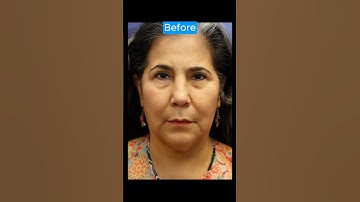 EPIC FACELIFT TRANSFORMATION