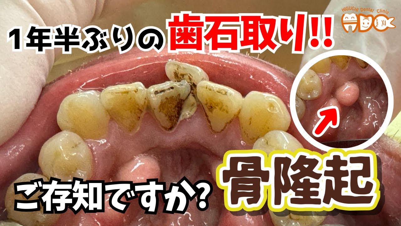 骨 隆起 手術 失敗