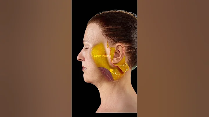 Deep plane facelift and neck lift ✨ #facelift #necklift #deepplanefacelift #kaminskyi