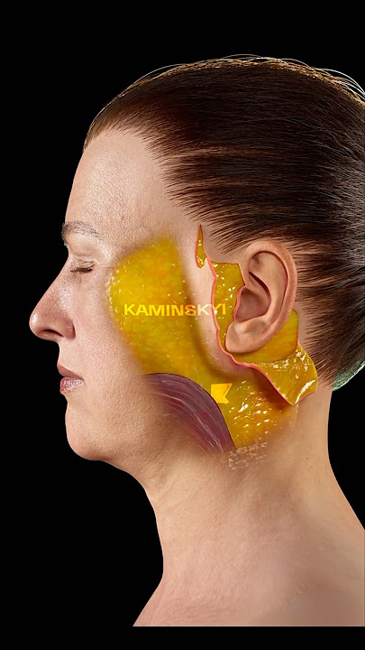 Deep plane facelift and neck lift ✨ #facelift #necklift #deepplanefacelift #kaminskyi