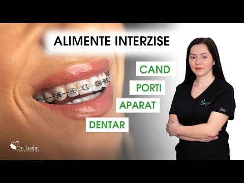 Video: 3 moduri de a evita obținerea aparatelor dentare