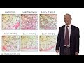 Bench to Bedside: Mesenchymal Stem Cells and ARDS, Part 2 - Michael Matthay