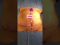 Awake tummy tuck and Lipo360 follow us on tiktok skindoctorplasticmd and Instagram @nuvueu