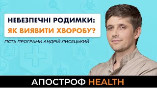 Меланома: як виявити небезпечні родимки та як вберегтись від раку шкіри? | Апостроф HEALTH