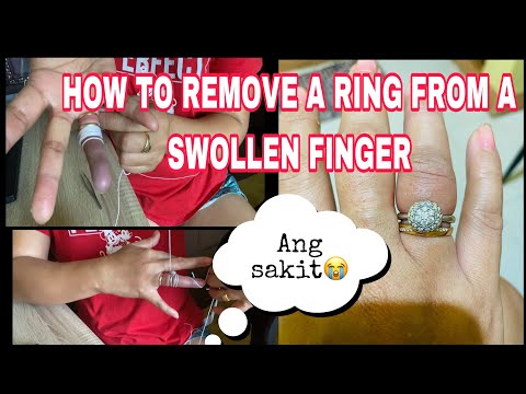 HOW TO REMOVE A RING FROM A SWOLLEN FINGER