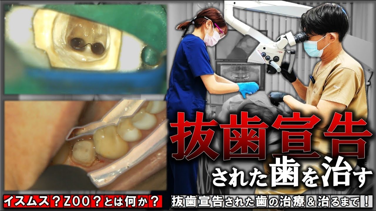 【裁断済み】抜髄 Initial Treatment Treating teeth that have been declared to be extracted! What is