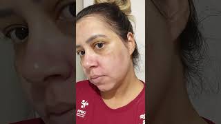 15 días usando flebon, tratando o melasma melasmatratamento