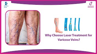 Painful Varicose Veins Treated without Surgery | Bulging Veins  -  Dr.  Junaid | Doctors' Circle