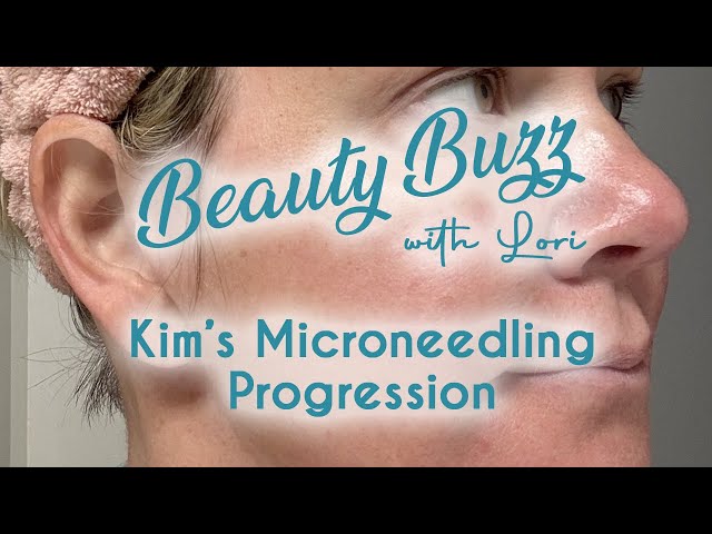 Beauty Buzz with Lori: Kim's Microneedling Progression