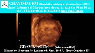 Gravimagem 16807 Ultrom Morfológico 4D Em Gravidez Com 22 Semanas