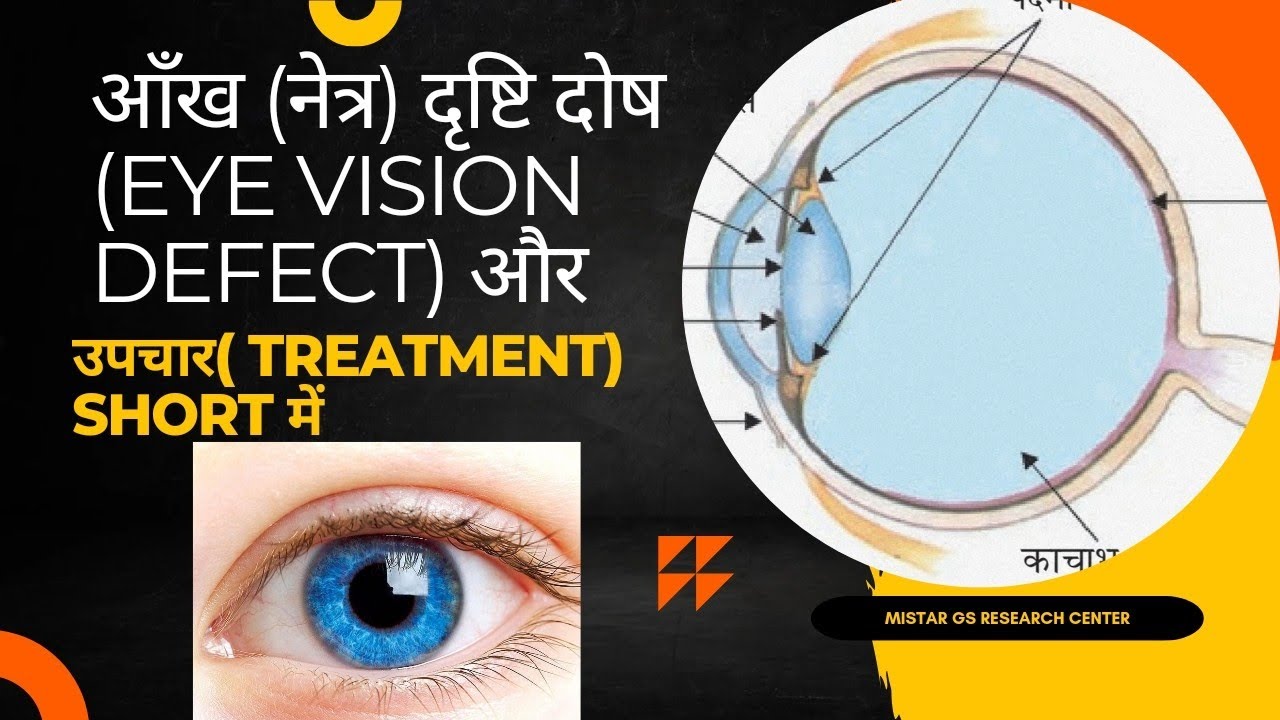 नेत्र (आँख) दृष्टि दोष(Eye Vision Defect) क्या है? विभिन्न प्रकार के ...