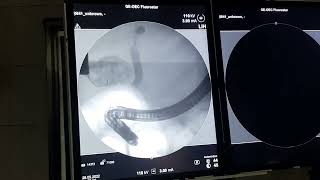 ERCP with double drainage of suppurative ascending cholangitis and gallbladder empyema