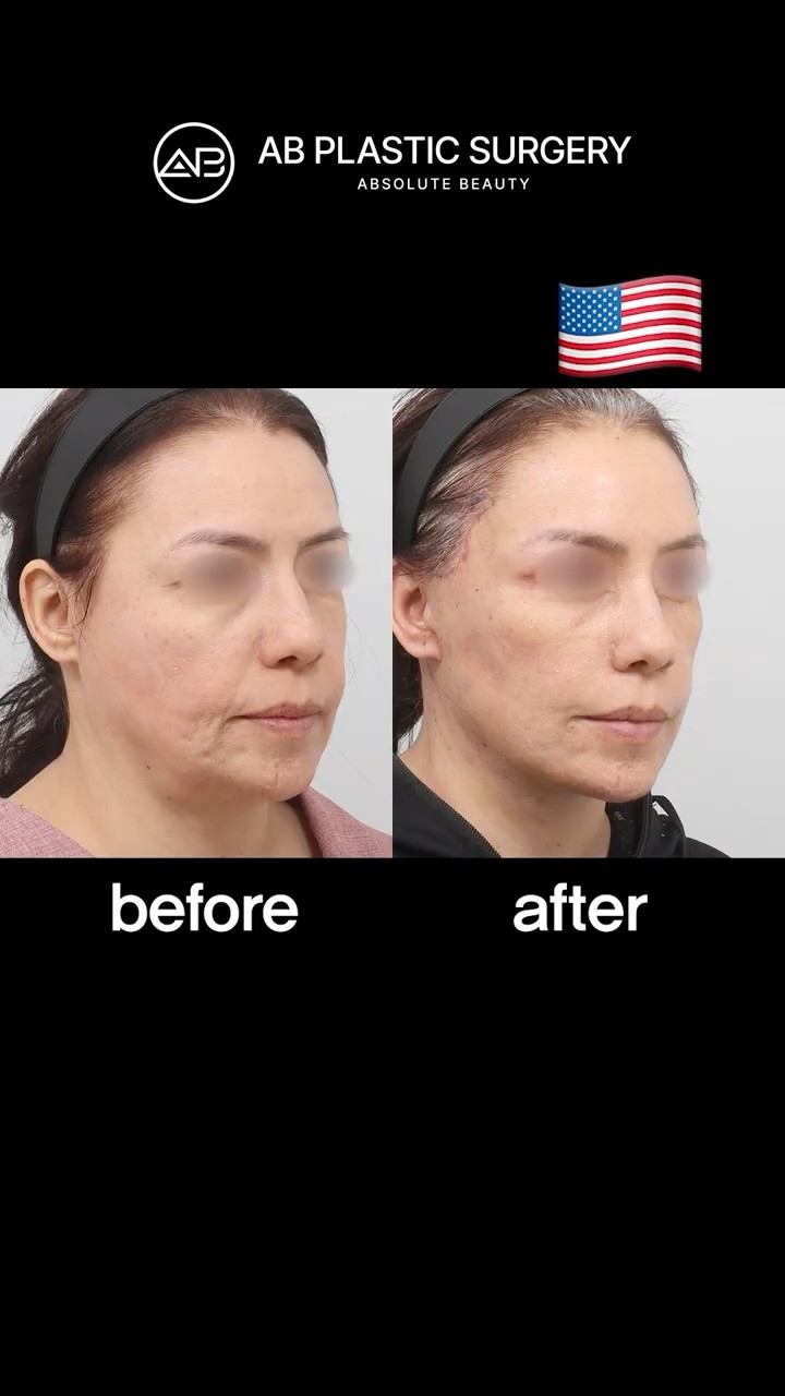 From Tired to Refreshed | Facelift Before & After #shorts