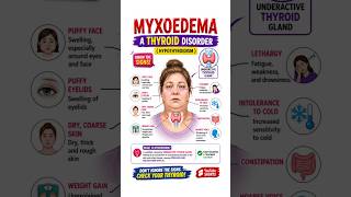 Myxoedema Explained in 60 Seconds! 🚨 Signs of Severe Hypothyroidism #Thyroid #Myxoedema #Shorts