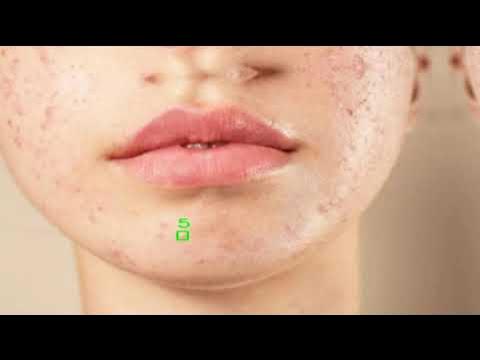 Discover the cutting-edge technology of automated acne detection using ...