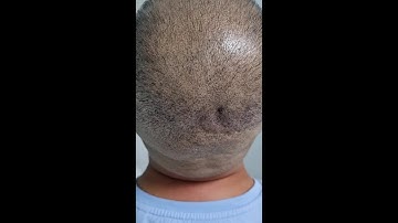 Scalp Micropigmentation Male SMP density restoration 1st session by El Truchan