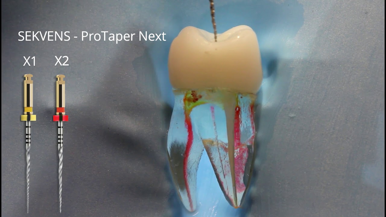 Shaping mb1 ProTaper Next - YouTube