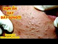 Điều trị dày sừng nang lông tại TPHCM | HIỀN VÂN SPA |Remove Keratosis Pilaris Atrophicans| 635