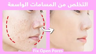 How To Get Rid Of Large Pores On Face | التخلص من المسامات الواسعة بطريقة طبيعية