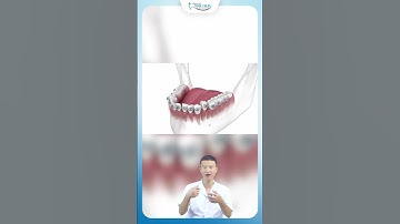 Niềng Răng Lệch Lạc | Nha Khoa Minh Châu