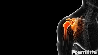 Treatment of Calcification - Calcific Tendinitis - By Premilife