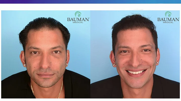 Panel of Discussion with Renowned Hair Loss Expert...