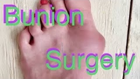 Lapiplasty Bunionectomy foot surgery