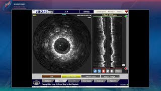 In-Stent Restenosis: Superficial Femoral Artery - LINC 2018 LC 4 Sinai_ Krishnan - Tues 10:33am