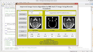 Matlab Project Image Fusion on MRI And CT Image Using Wavelet Transform