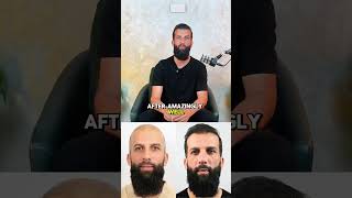 Moeen Alis Robotic Hair Transplant With Este Medical Group