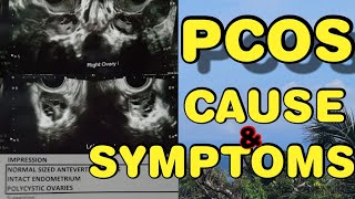 PCOS |LEARN ABOUT POLYCYSTIC OVARIES | CAUSE &amp; SYMPTOMS