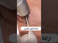 ازاله تاتو الحواجب بالليزر شيرين عبدالوهاب ازاله تاتو الحواجب بالليزر شيرين عبدالوهاب