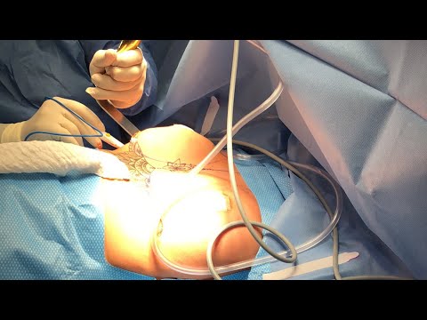 Download 480CC Breast Augmentation Dr Jeneby Plastic Surgery In San Antonio