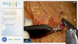 Watch Live Back Treatment! Anterior Cervical Discectomy &amp; Fusion (ACDF) C5-C6, C6-C7