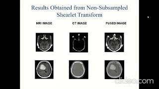 Multimodal Medical Image Fusion using Non-Sub Sampled Shearlet Transform