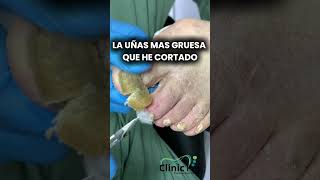 Uña mas GRUESA y la mas LARGA  #nails #pedicure #foot #asmr #satisfying #podologia