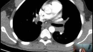 Chest Ct Discussion 22Yom W Pulmonary Emboli Discussed By Radiologist