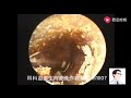 Use ear endoscope to clean bilateral external auditory canal fungus for 12 minutes. 使用耳内镜清理双侧外耳道真菌