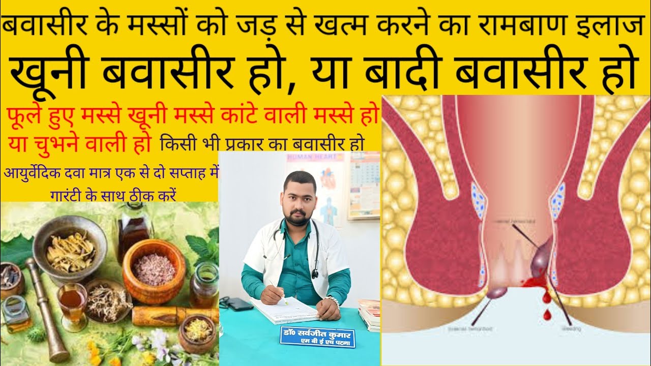 Bavasir ka ramban ilaaj , khooni ho ya Badi, बवासीर का रामबाण इलाज खूनी ...