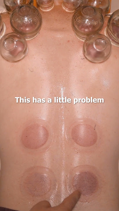 ASMR: Chinese Chiropractic and Cupping Fixes my Neck and Back Pain! #shorts