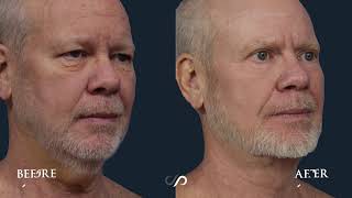 Traceless Neck lift On a 58-year-old Man | Before and After Video | Dr. David Stoker