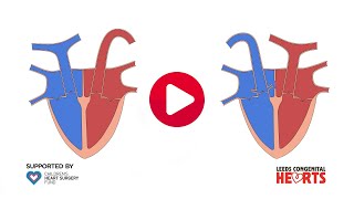 Transposition of the Great Arteries